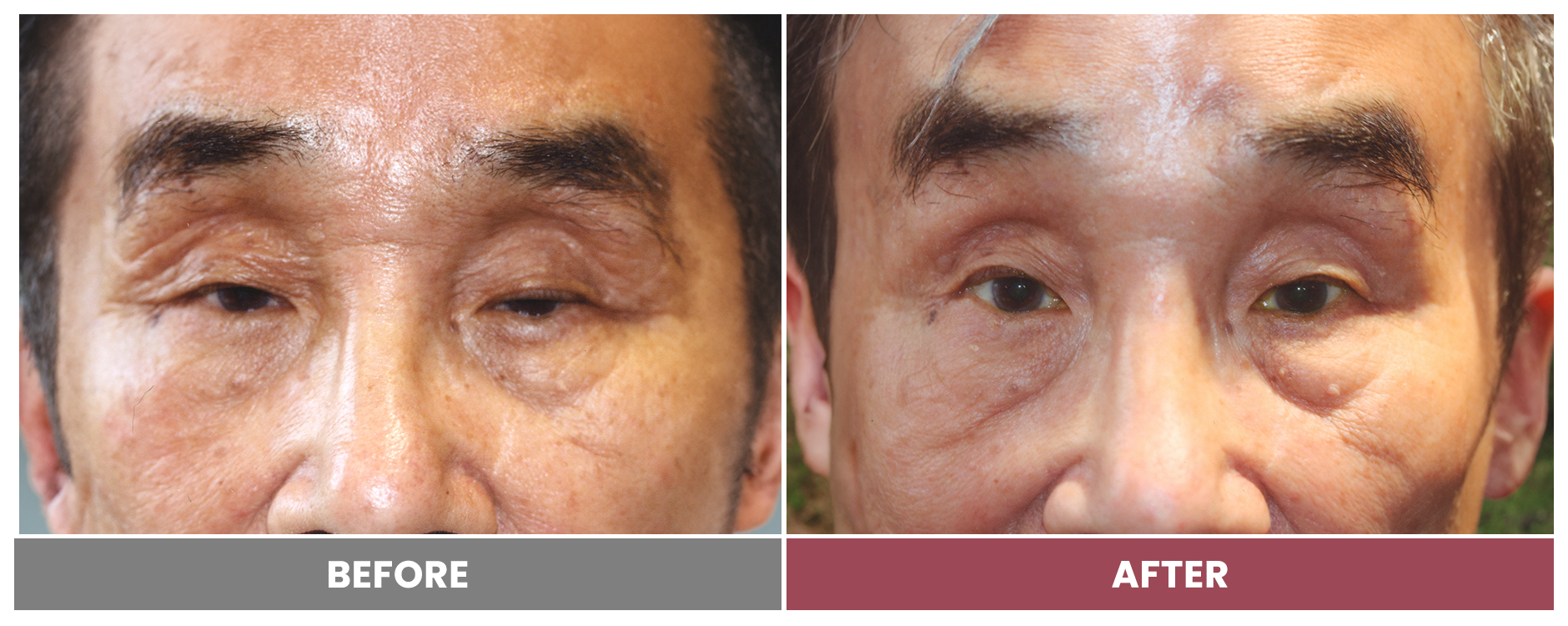 PTOSIS REPAIR - Case 22